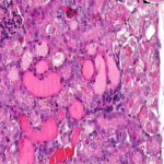 Cisplatin induced AKI model